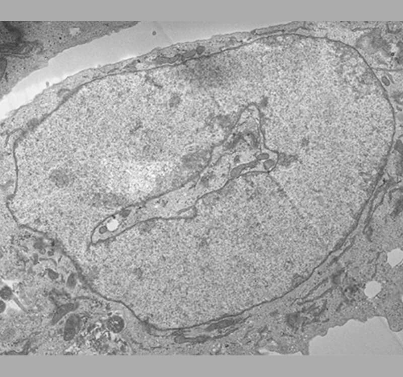 LAP1 Patient Nucleus (with trans-nuclear channel)