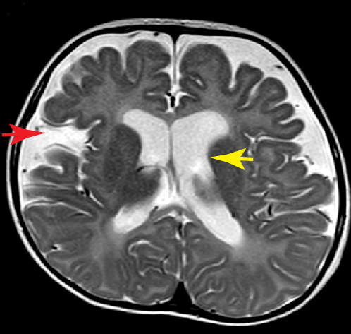 Read more about the article Neurodegeneration and the Nuclear Envelope